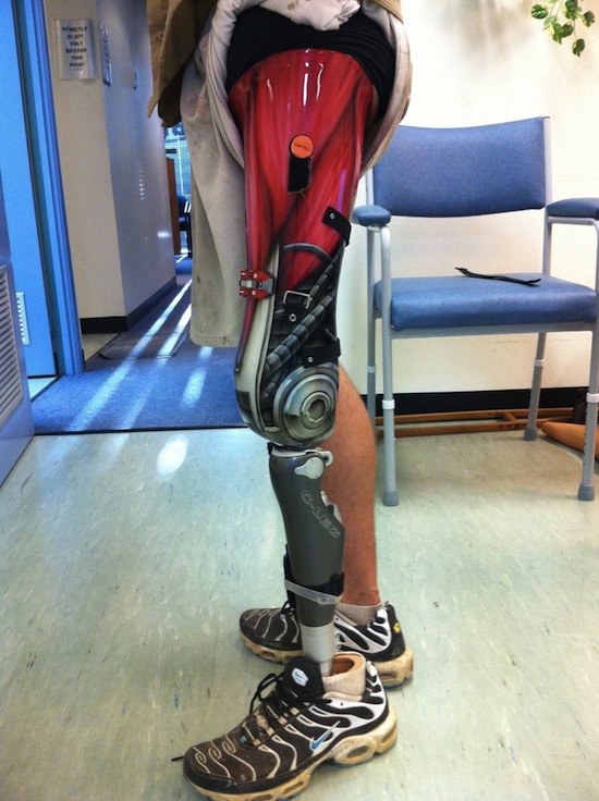 exoskeletal prosthesis